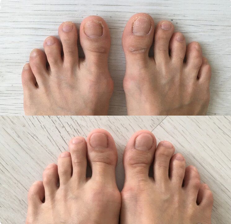 before and after using Foot tropper spray